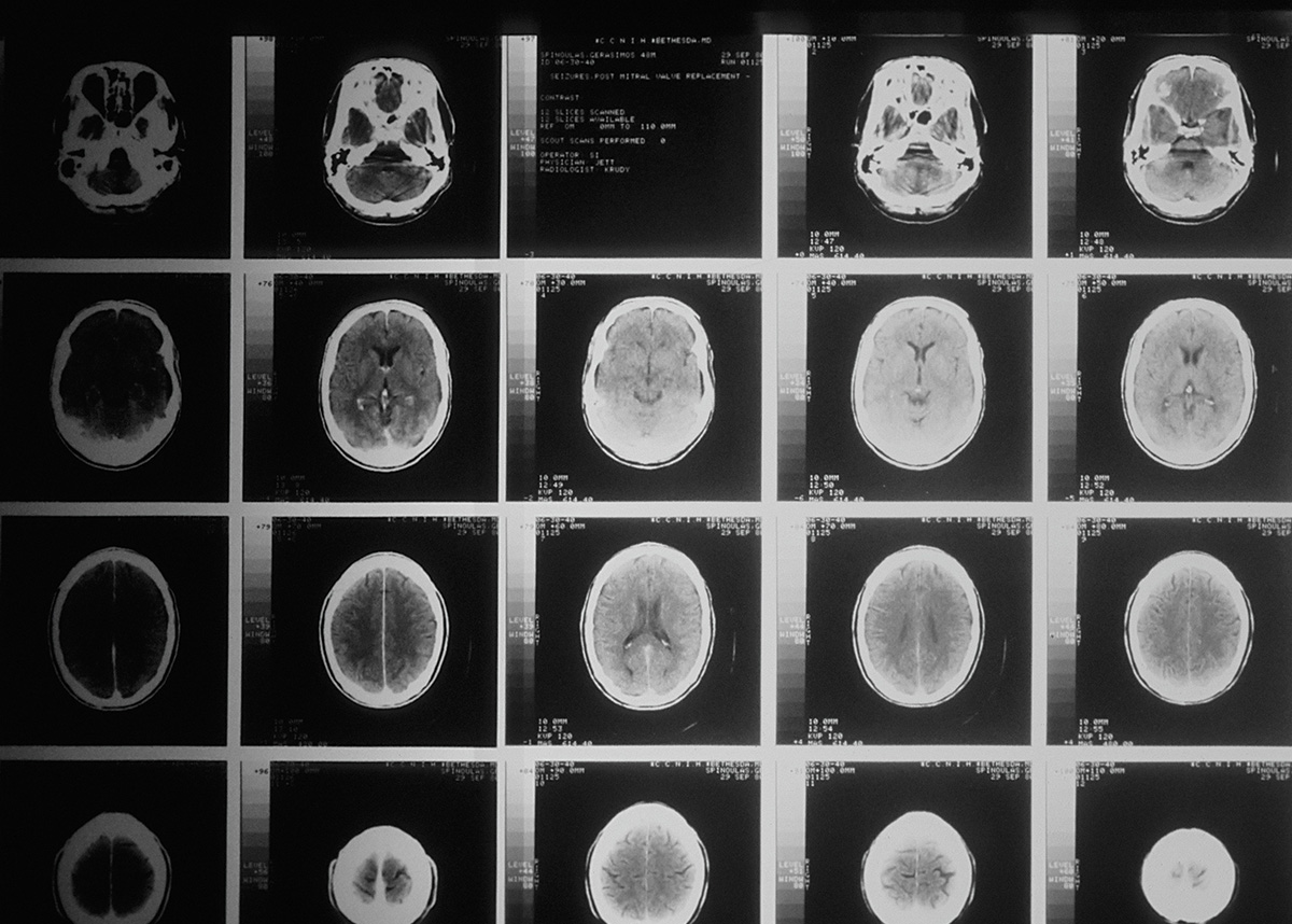 CT scans of brain