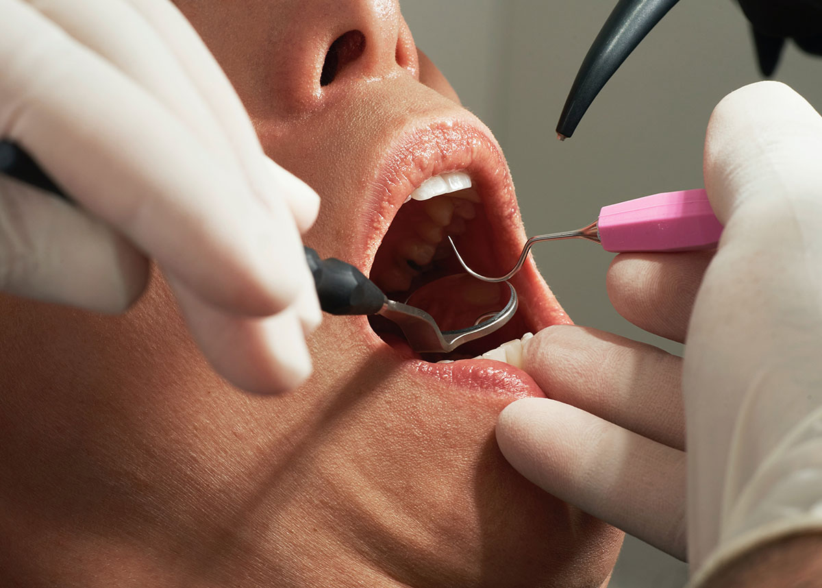 Close up of a dentist working in a persons mouth